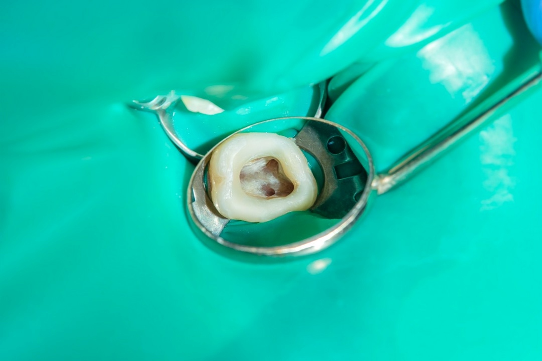 leczenie endodontyczne